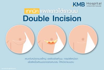 เทคนิคแผลยาวใต้ราวนม