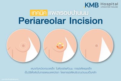 เทคนิคแผลรอบปานนม