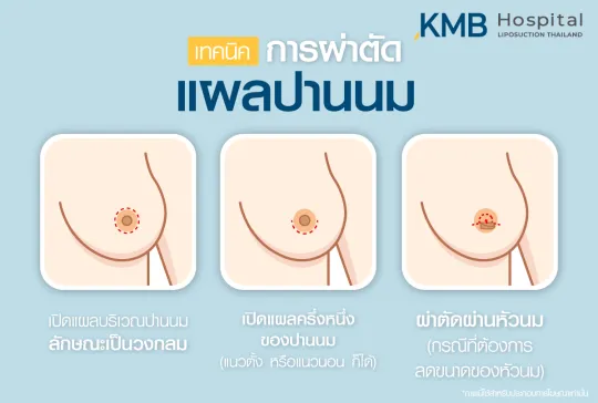 เทคนิคการผ่าตัดแผลปานนม