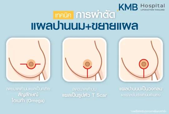 เทคนิคการผ่าตัดแผลปานนมและขยายแผล