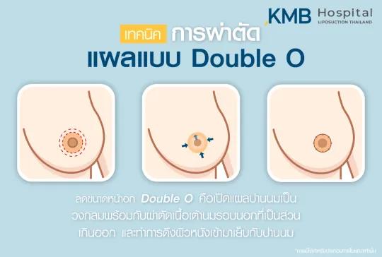 เทคนิคการผ่าตัดแผลแบบ Double O