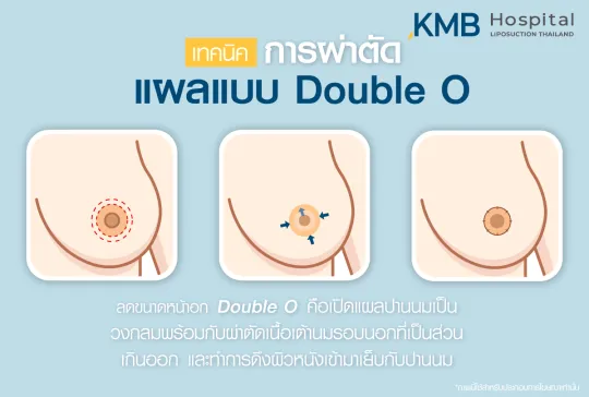 เทคนิคการผ่าตัดแผลแบบ Double O
