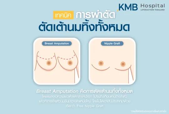 เทคนิคการผ่าตัดเต้านมทิ้งทั้งหมด