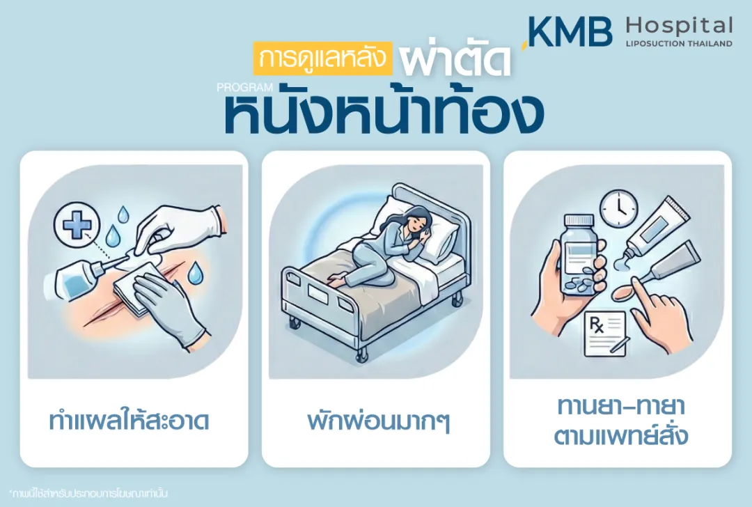 การดูแลหลังผ่าตัดหนังหน้าท้อง