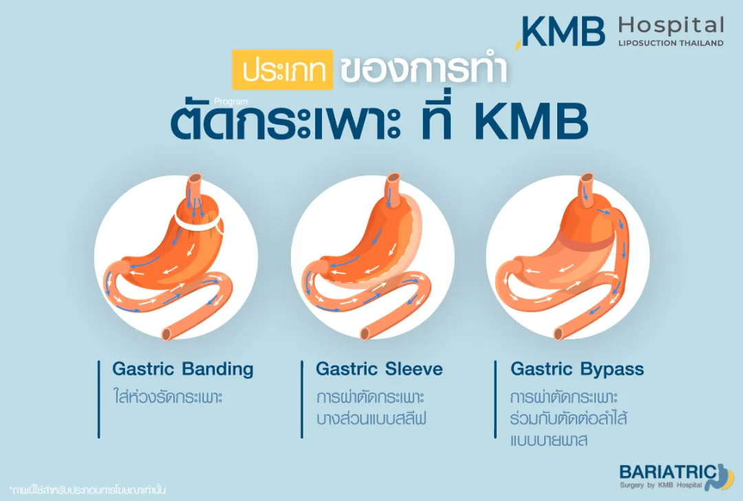ประเภทของการตัดกระเพาะ