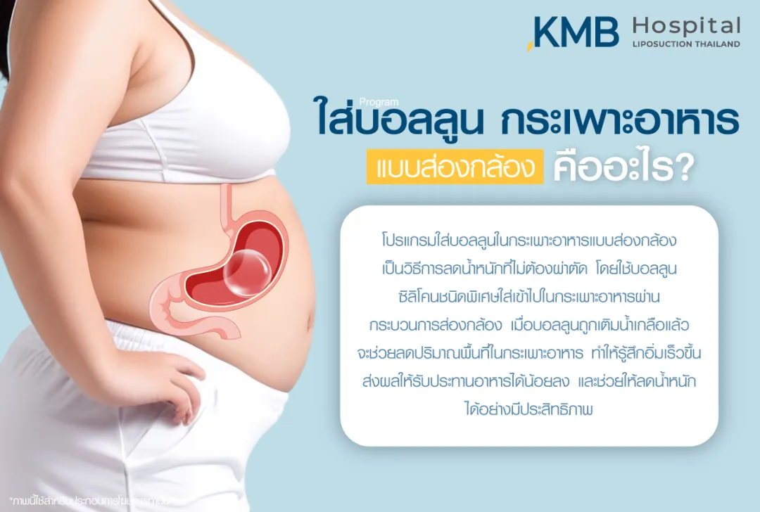 ใส่บอลลูนกระเพาะอาหาร คืออะไร