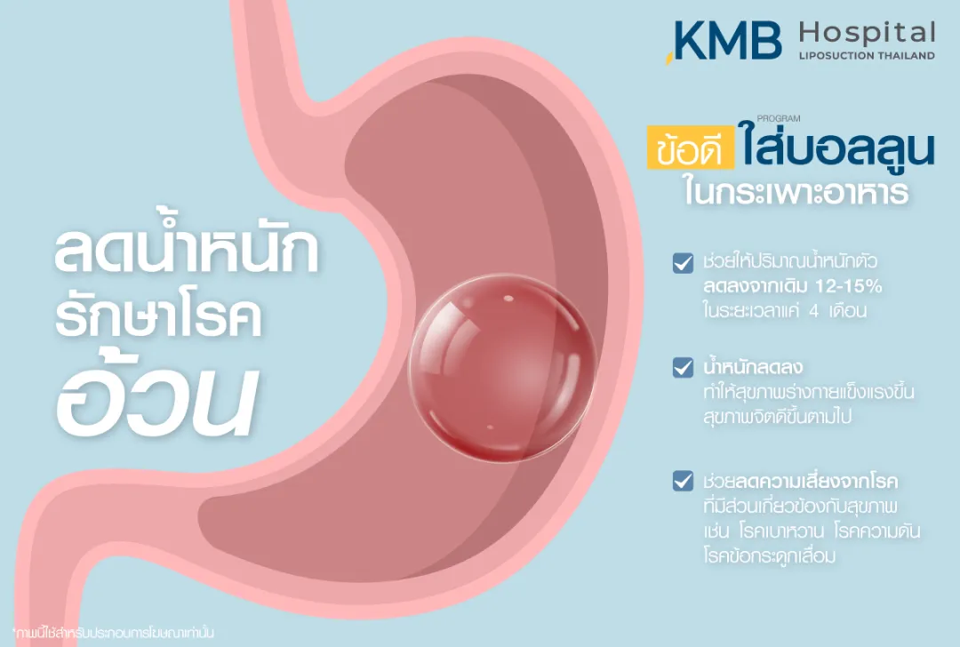 ข้อดีใส่บอลลูนกระเพาะอาหาร