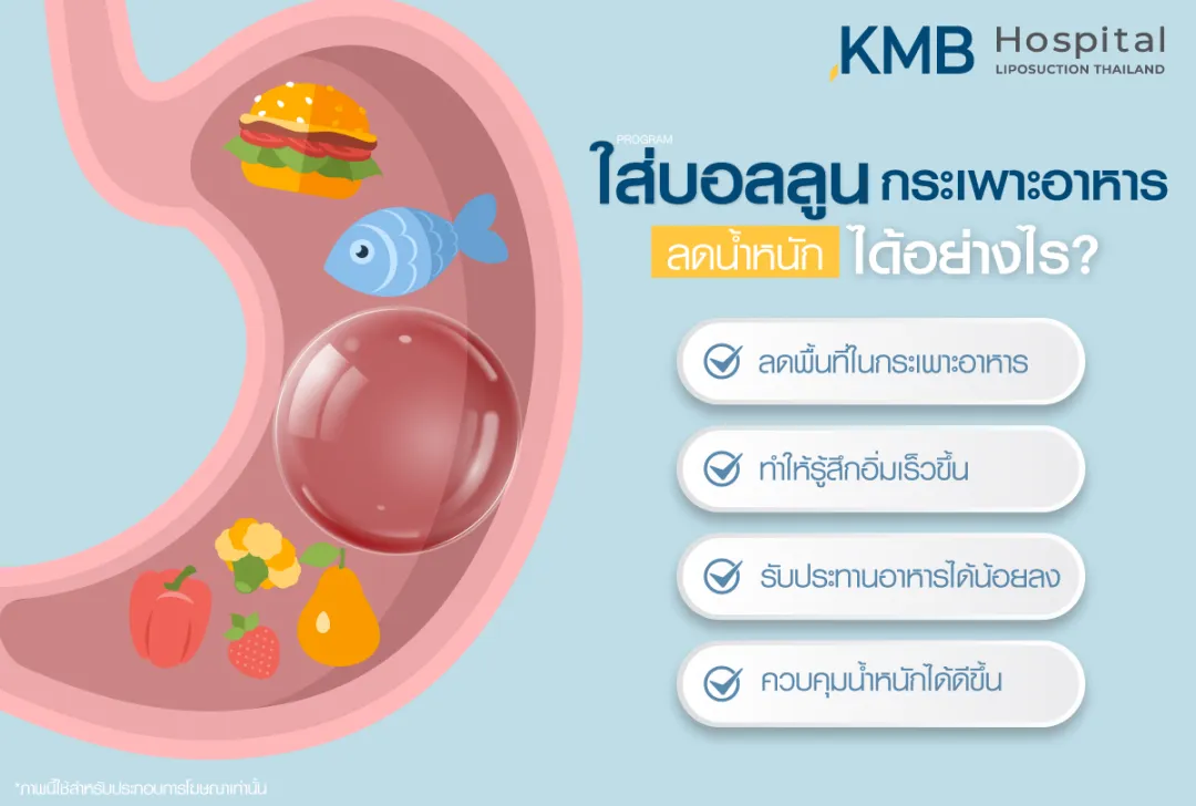ใส่บอลลูนกระเพาะอาหารลดน้ำหนักได้อย่างไร