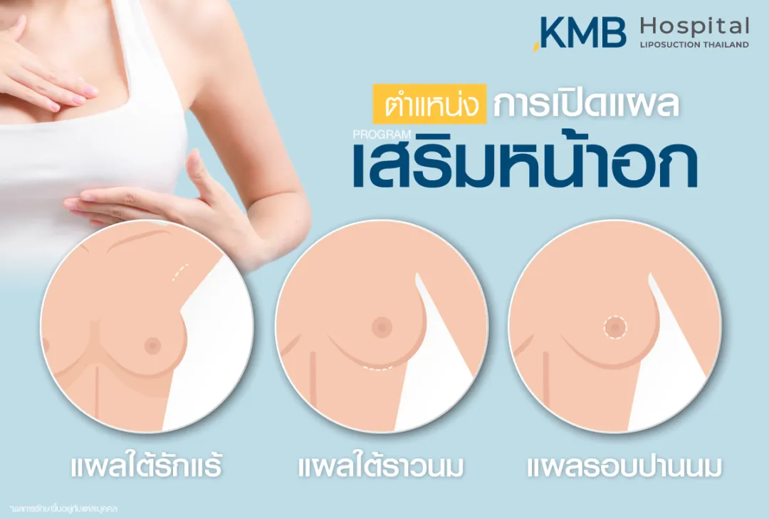 ตำแหน่งการเปิดแผลเพื่อเสริมหน้าอก