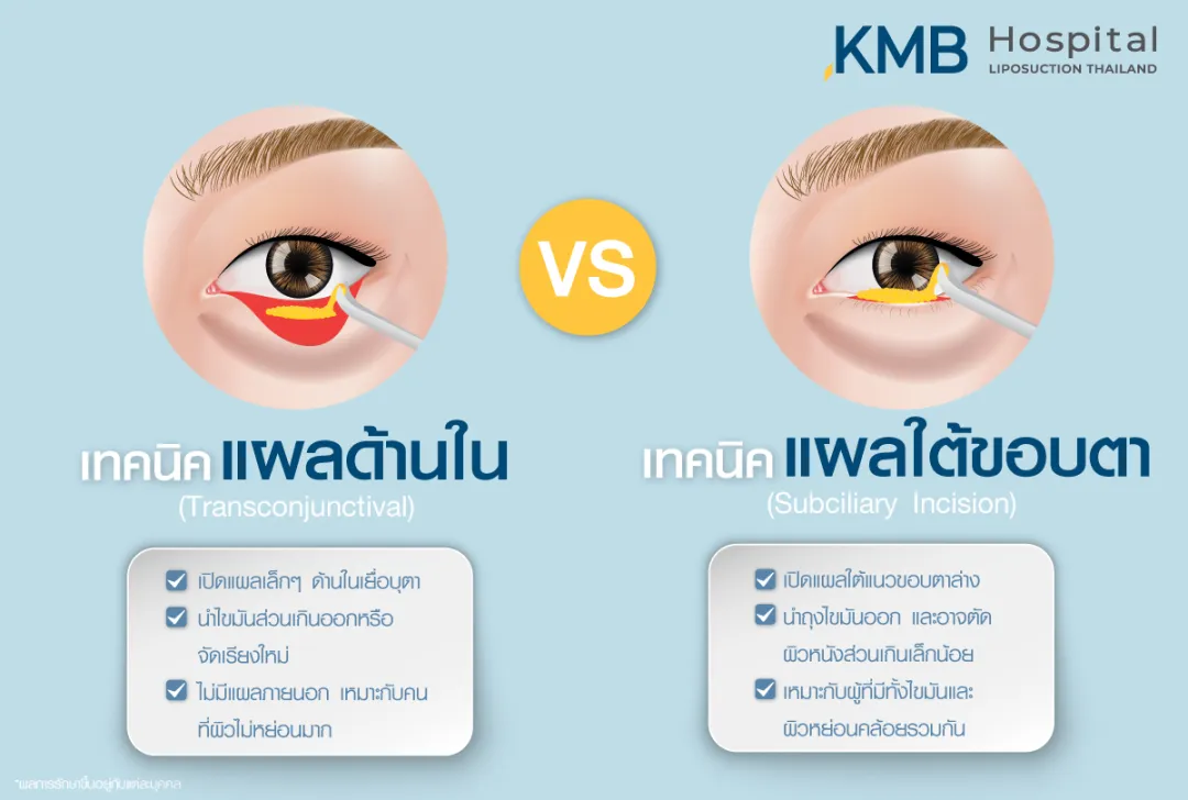 เทคนิคแผลด้านใน VS เทคนิคแผลใต้ขอบตา