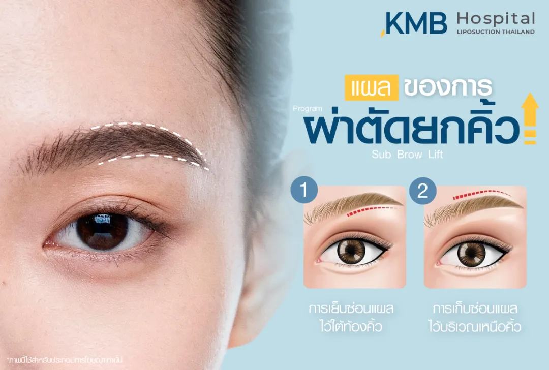 แผลของการผ่าตัดยกคิ้ว