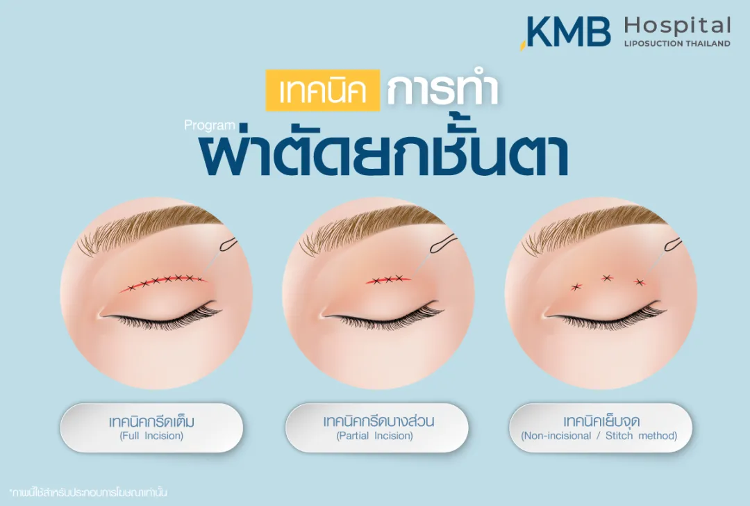 เทคนิคการผ่าตัดยกชั้นตา