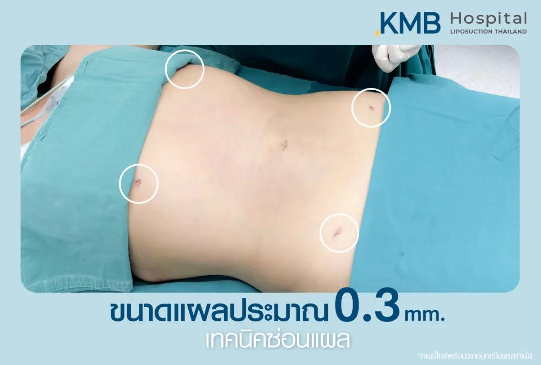 เทคนิคซ่อนแผล