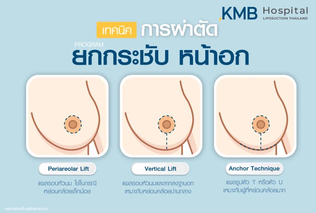 เทคนิคผ่าตัดยกกระชับหน้าอก