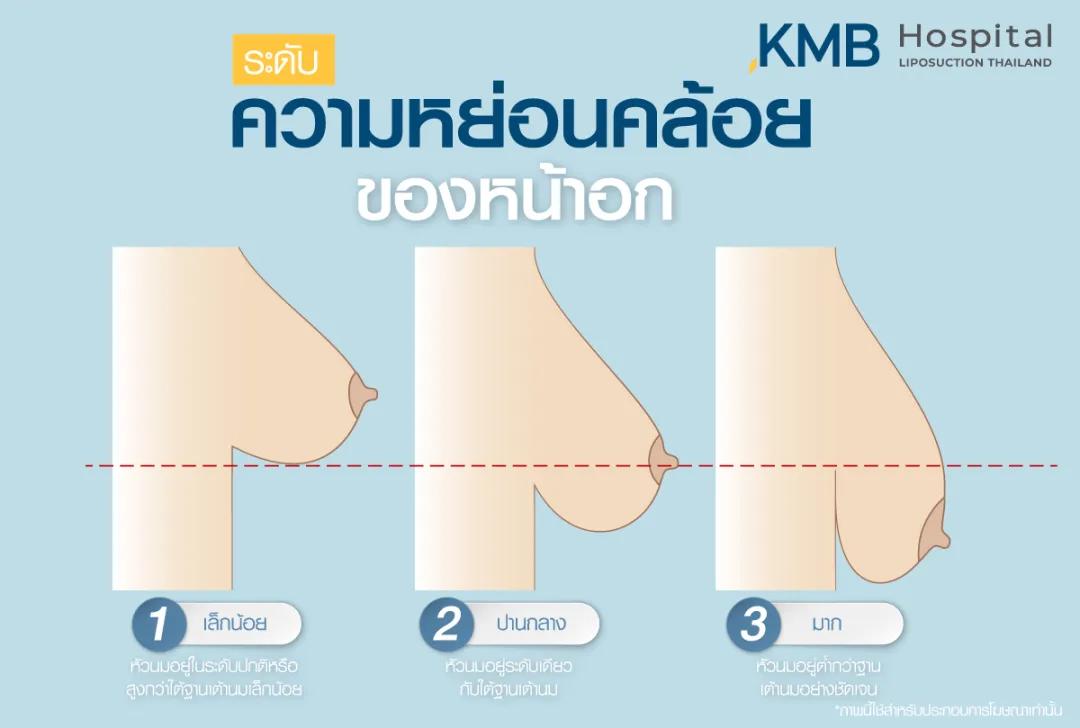 ระดับความหย่อนคล้อยของหน้าอก