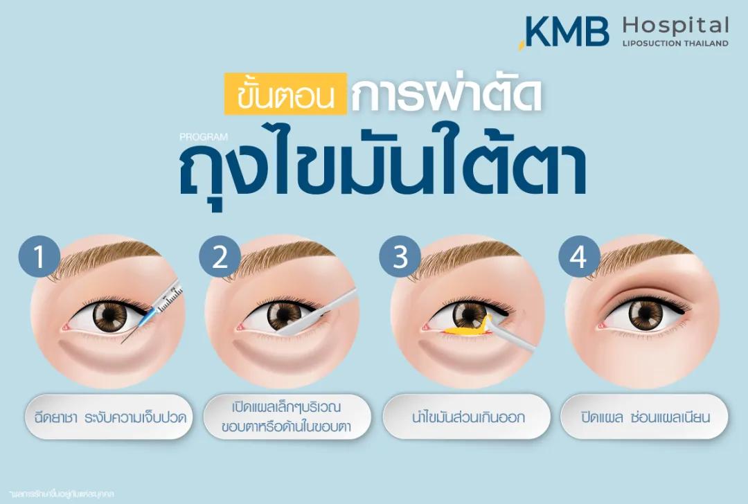 ขั้นตอนการผ่าตัดถุงใต้ตา