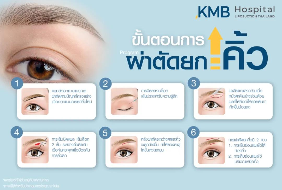 ขั้นตอนการผ่าตัดยกคิ้ว