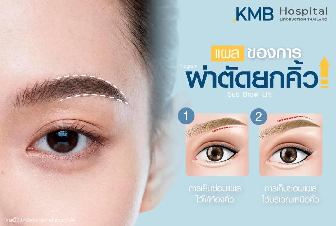 แผลของการผ่าตัดยกคิ้ว