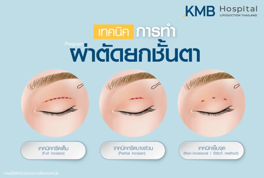 เทคนิคการผ่าตัดยกชั้นตา